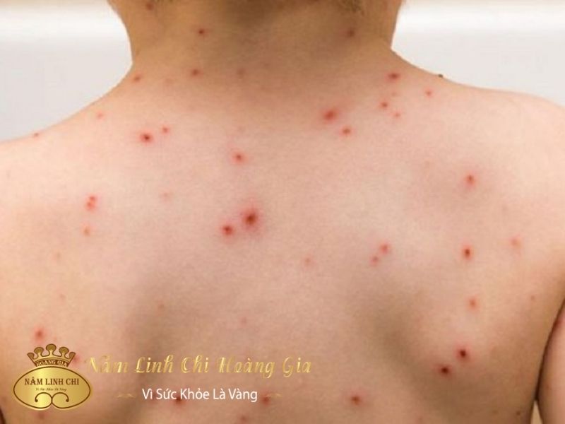 bi-thuy-dau-1 bi-thuy-dau